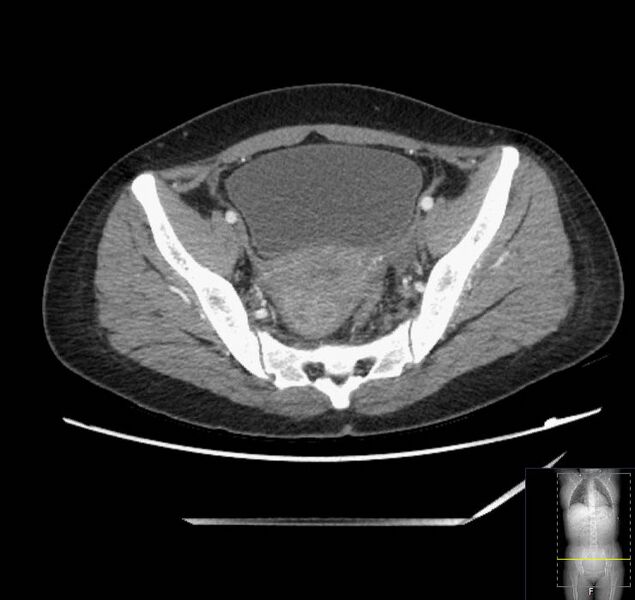 File:Appendicitis (CT angiogram) (Radiopaedia 154713-127660 Axial 22).jpg