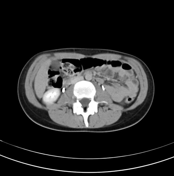File:Appendicitis and incidental bicornuate uterus (Radiopaedia 22833-22853 Axial C+ delayed 15).jpg