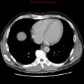 Appendicitis and renal cell carcinoma (Radiopaedia 17063-16760 A 1).jpg