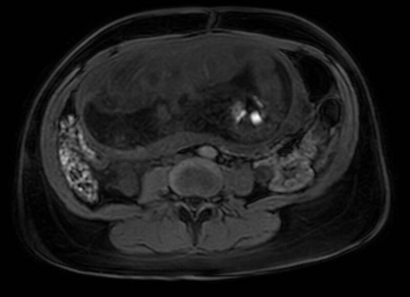 File:Appendicitis in gravida (MRI) (Radiopaedia 89433-106395 Axial DIXON 78).jpg