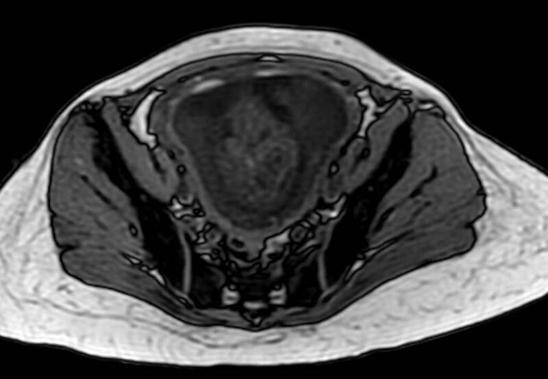 File:Appendicitis in gravida (MRI) (Radiopaedia 89433-106395 D 56).jpg