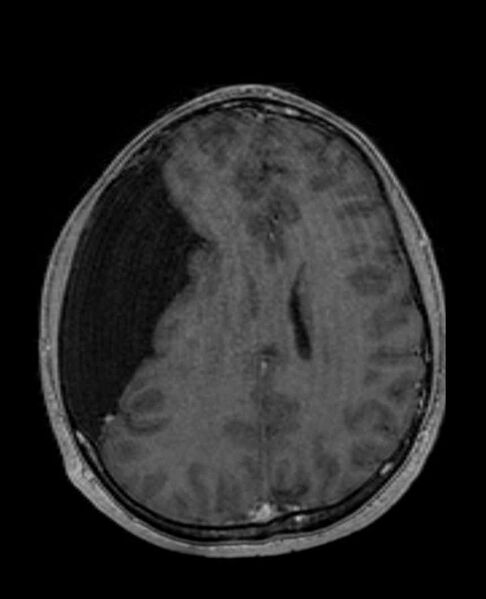 File:Arachnoid cyst- extremely large (Radiopaedia 68741-78451 Axial T1 C+ 52).jpg