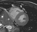 Arrhythmogenic right ventricular cardiomyopathy (Radiopaedia 39806-42237 F 9).jpg