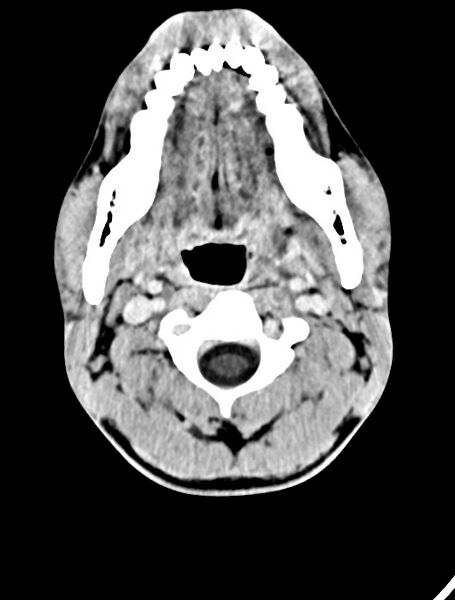File:Arrow injury to the face (Radiopaedia 73267-84011 Axial C+ delayed 20).jpg