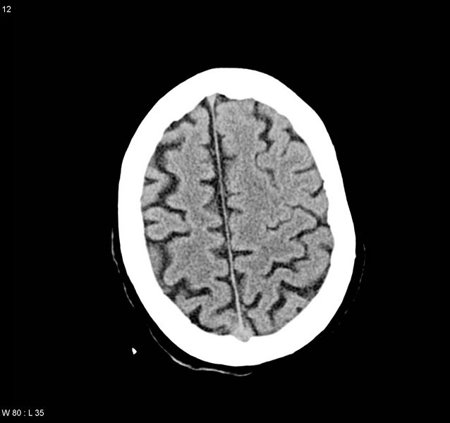 File:Arteriovenous malformation - cerebral (Radiopaedia 8172-9020 Axial non-contrast 20).jpg