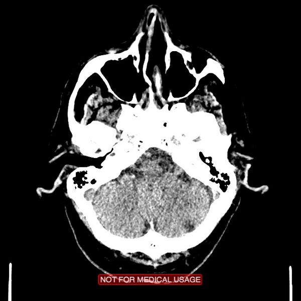 File:Artery of Percheron infarction (Radiopaedia 28679-28967 Axial non-contrast 24).jpg