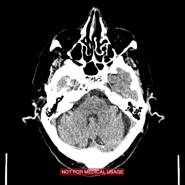 File:Artery of Percheron infarction (Radiopaedia 28679-28967 Axial non-contrast 30).jpg