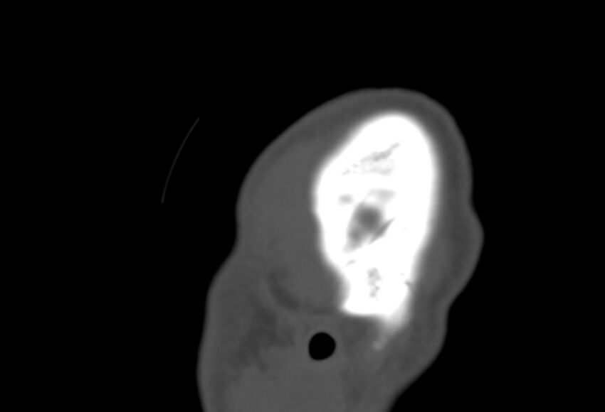 Asymptomatic occipital spur (Radiopaedia 87753-104201 Sagittal bone window 308).jpg