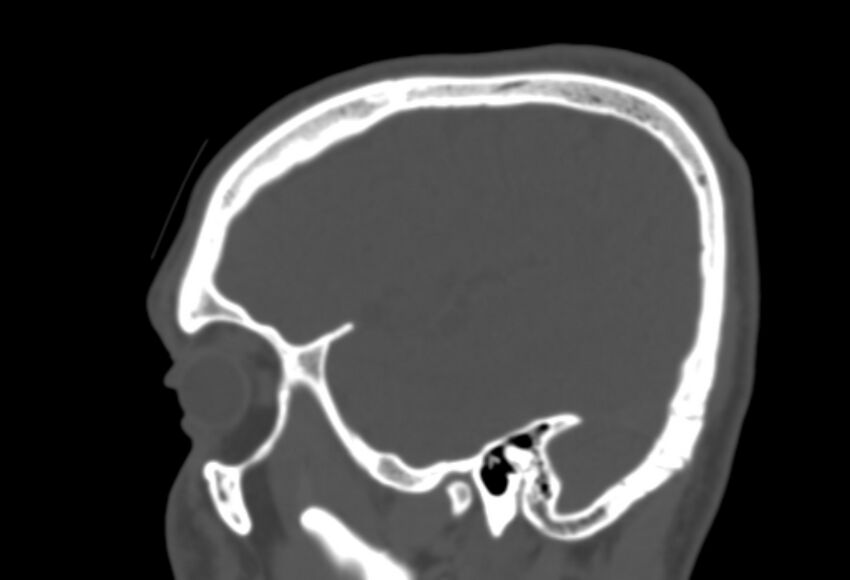 Asymptomatic occipital spur (Radiopaedia 87753-104201 Sagittal bone window 56).jpg