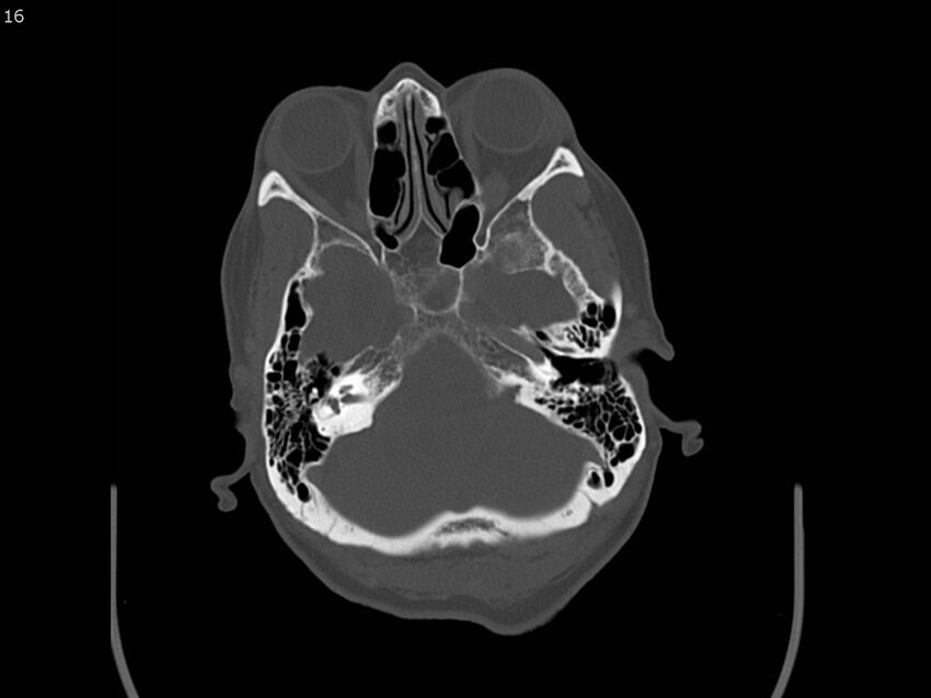 Atypical meningioma - intraosseous (Radiopaedia 64915-73867 Axial C+ bone window 16).jpg
