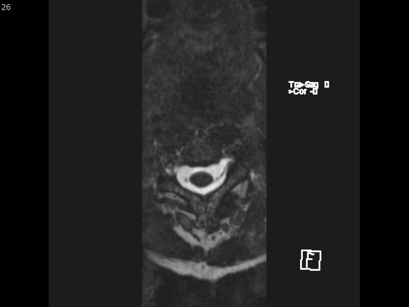 File:Atypical meningioma - intraosseous (Radiopaedia 64915-74572 Axial CISS 26).jpg