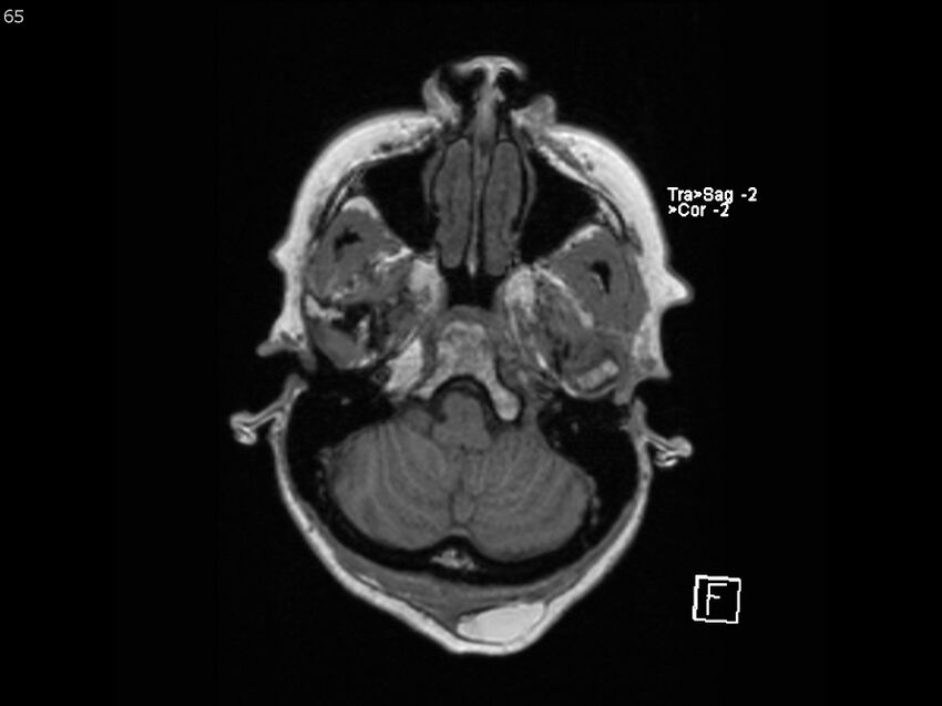 Atypical meningioma - intraosseous (Radiopaedia 64915-74572 Axial T1 65).jpg