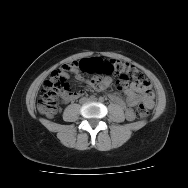File:Autosomal dominant polycystic kidney disease (Radiopaedia 23061-23093 Axial non-contrast 41).jpg