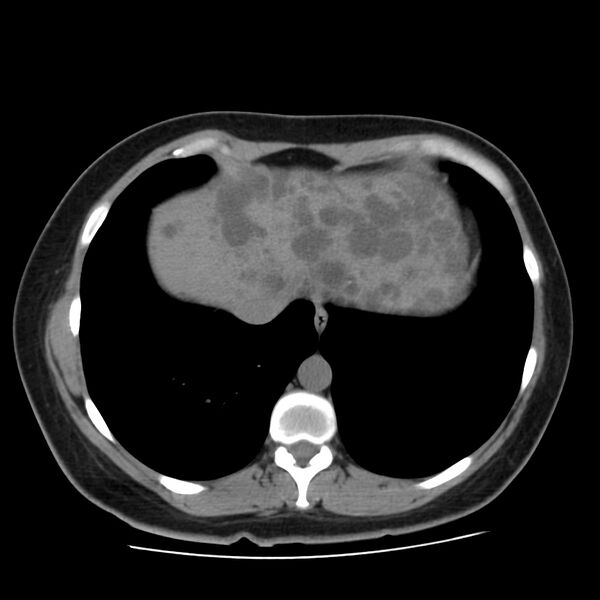 File:Autosomal dominant polycystic kidney disease (Radiopaedia 23061-23093 Axial non-contrast 5).jpg