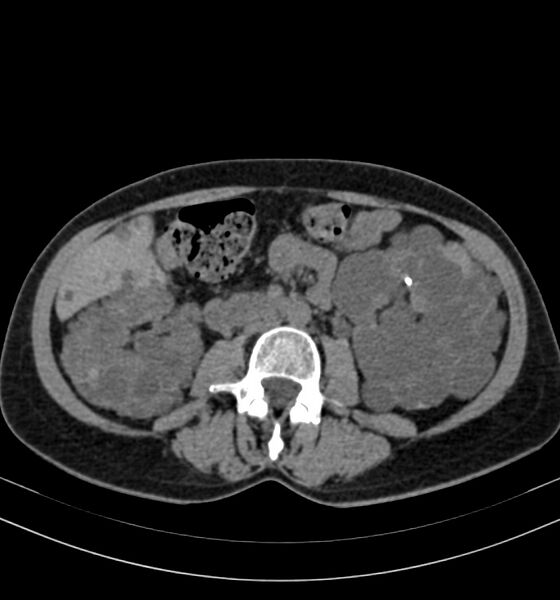 File:Autosomal dominant polycystic kidney disease (Radiopaedia 41918-44922 Axial non-contrast 17).jpg
