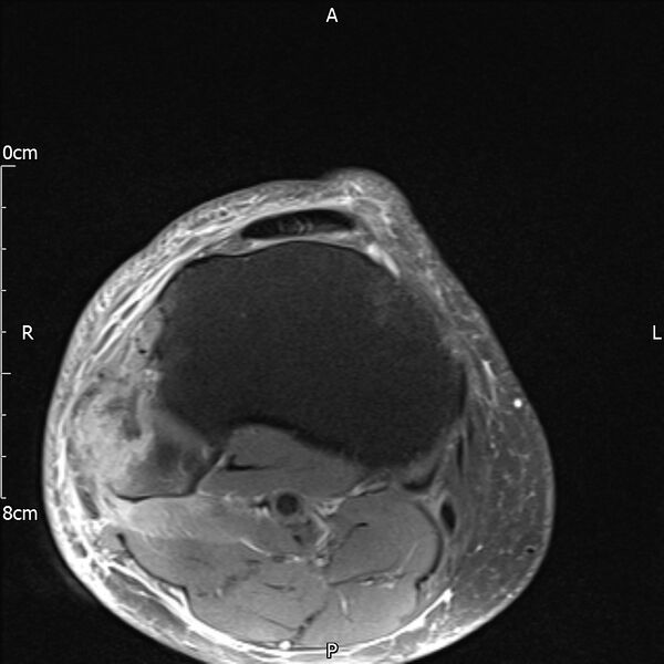 File:Avulsion fracture of the fibular head (Radiopaedia 74804-85808 Axial PD fat sat 31).jpg