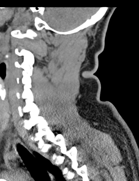 File:Axis peg fracture (type 3) and atlas lateral mass (type 4) fracture (Radiopaedia 37474-39324 D 51).png