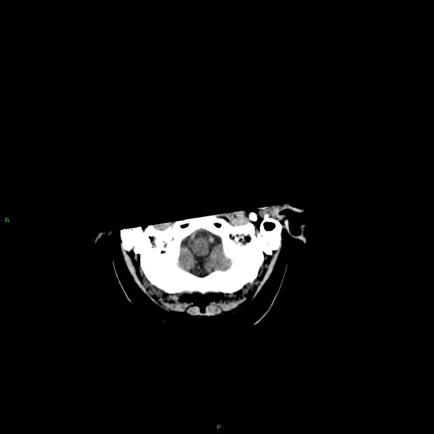 Basal ganglia hemorrhage (Radiopaedia 58346-65467 Axial non-contrast 51).jpg