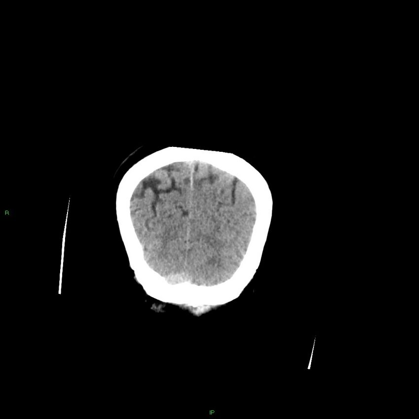 Basal ganglia hemorrhage (Radiopaedia 58349-65472 Coronal non-contrast 10).jpg