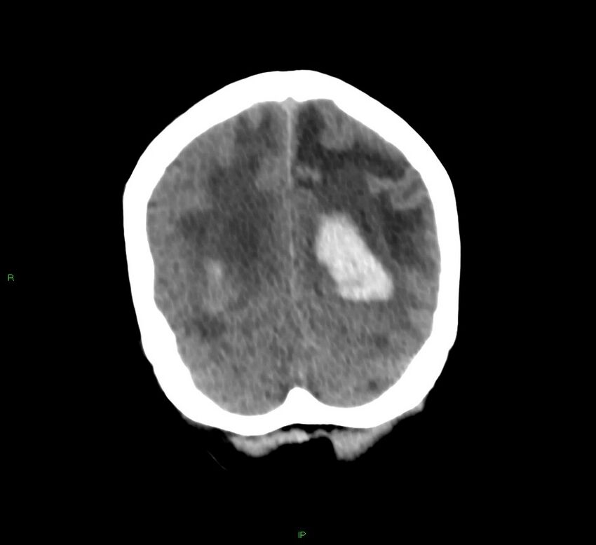 Basal ganglia hemorrhage (Radiopaedia 58766-65988 Coronal non-contrast 19).jpg