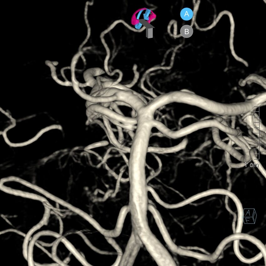Basilar artery perforator aneurysm (Radiopaedia 82455-97734 3D view left VA 110).jpg