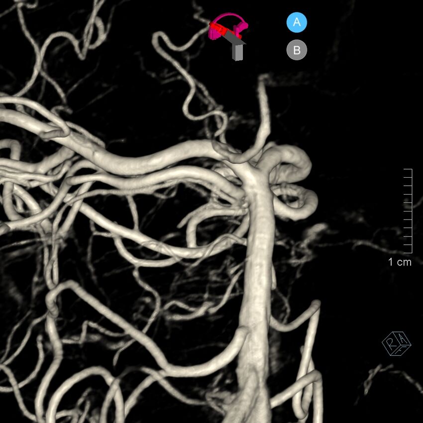 Basilar artery perforator aneurysm (Radiopaedia 82455-97734 3D view left VA 127).jpg
