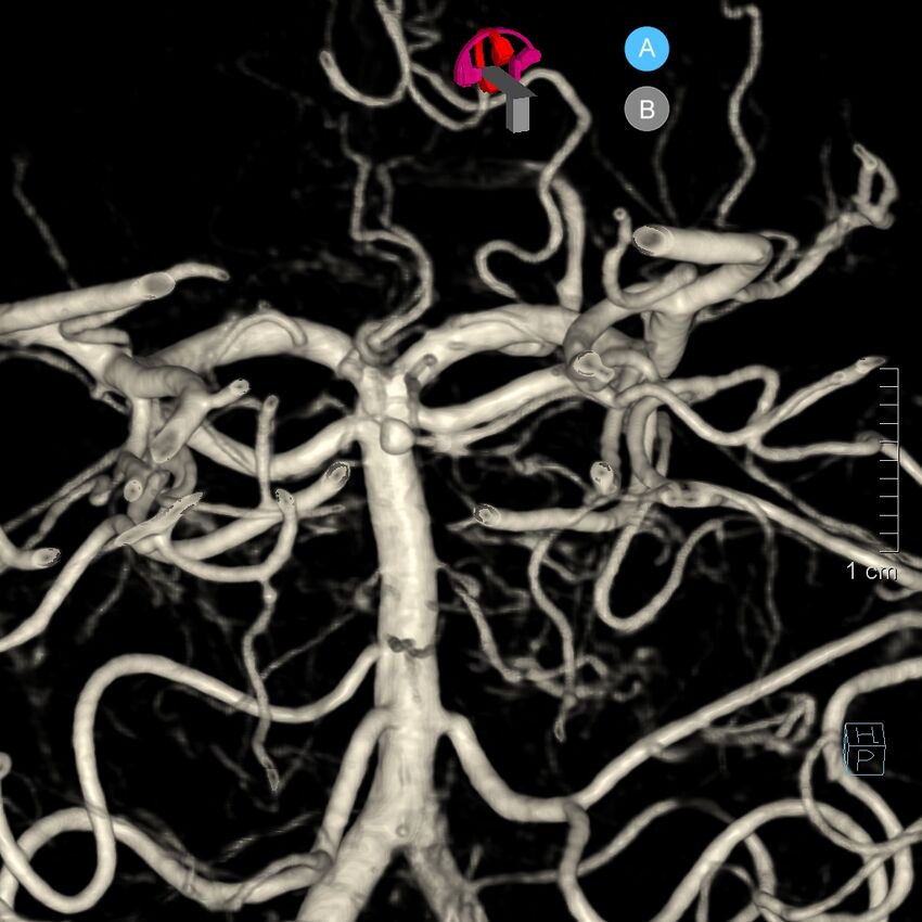 Basilar artery perforator aneurysm (Radiopaedia 82455-97734 3D view left VA 160).jpg