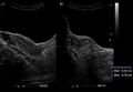 Bicornuate uterus (Radiopaedia 25059).jpg