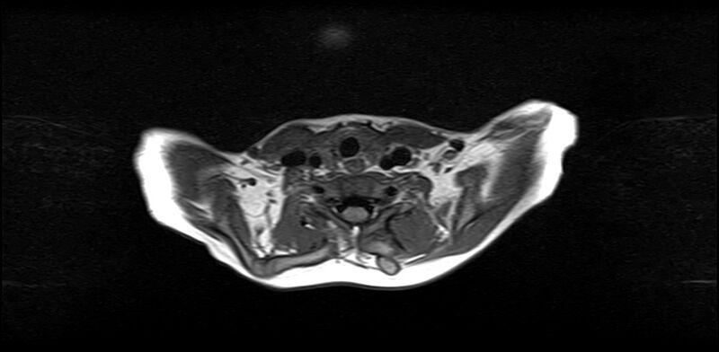 File:Bilateral Sprengel deformity with Klippel-Feil syndrome (Radiopaedia 66395-75650 Axial T1 16).jpg