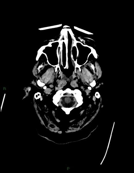 File:Bilateral acute middle cerebral artery territory infarcts (Radiopaedia 77319-89401 Axial non-contrast 2).jpg