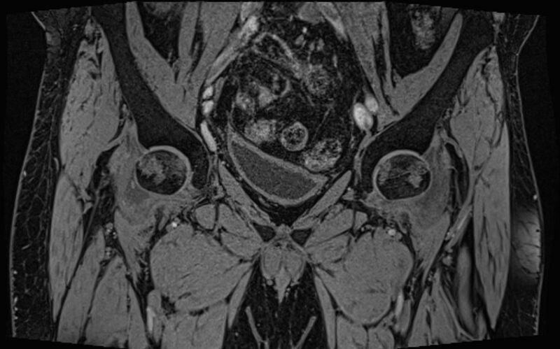 File:Bilateral avascular necrosis of femoral head (Radiopaedia 77116-89078 Coronal T2 we 63).jpg