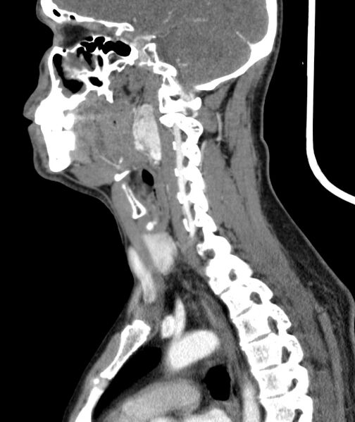 File:Bilateral carotid body tumors (Radiopaedia 52899-58827 C 33).jpg