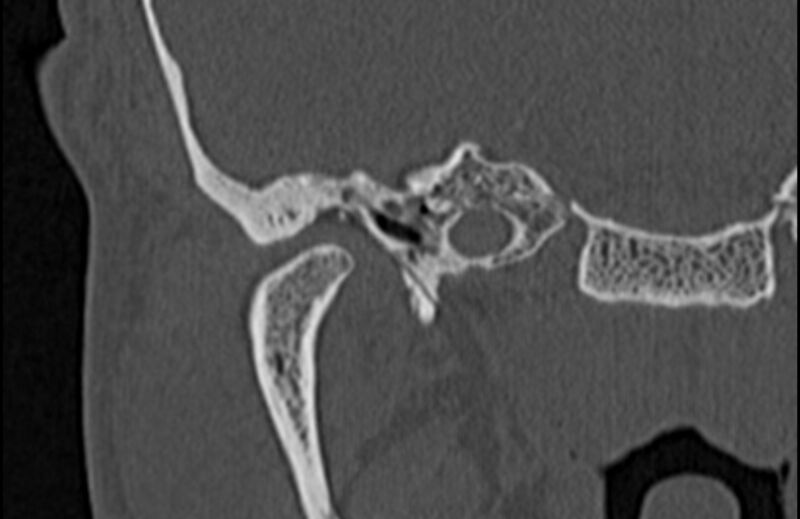 File:Bilateral cholesteatoma (Radiopaedia 54898-61172 Coronal bone window 15).jpg