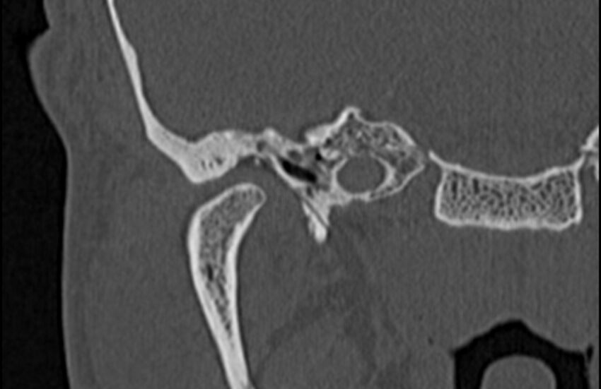 Bilateral cholesteatoma (Radiopaedia 54898-61172 Coronal bone window 15).jpg
