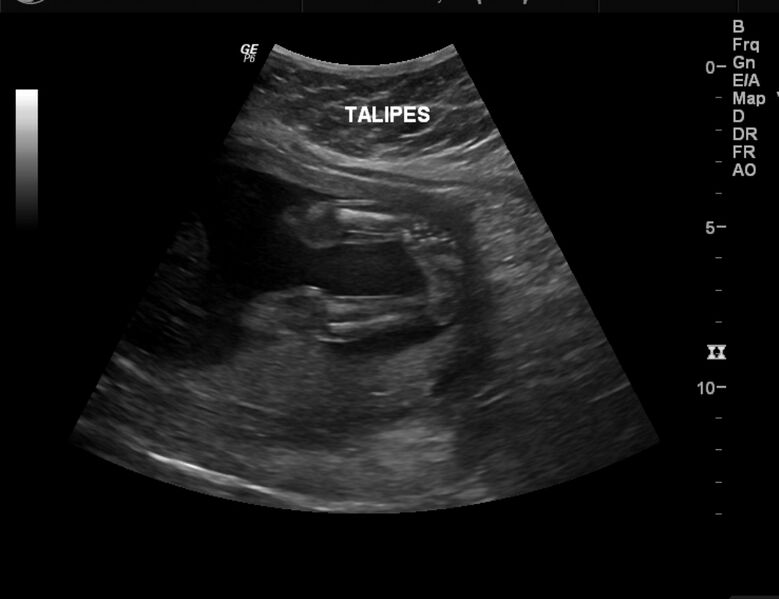 File:Bilateral congenital talipes equino-varus deformity in fetus (Radiopaedia 23337-23412 A 1).jpg