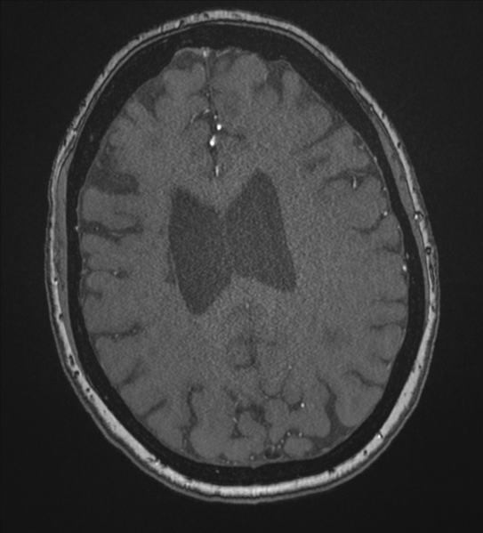 File:Bilateral fetal posterior communicating arteries (Radiopaedia 41286-44102 Axial MRA 154).png