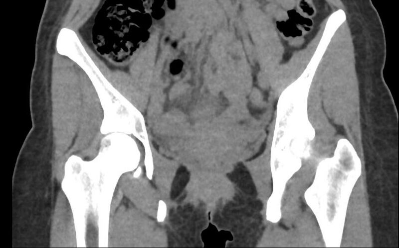 File:Bilateral mature cystic ovarian teratoma (Radiopaedia 88821-105592 Coronal non-contrast 8).jpg