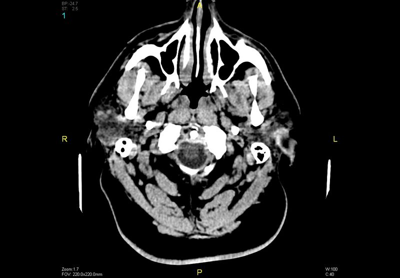 File:Bilateral medial medullary infarction (Radiopaedia 42220-45295 Axial non-contrast 1).jpg
