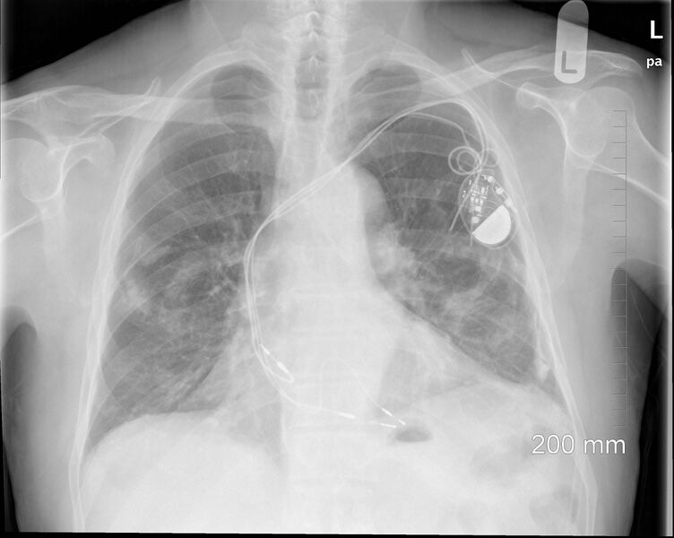 File:Biventricular pacemaker (Radiopaedia 52610).jpg