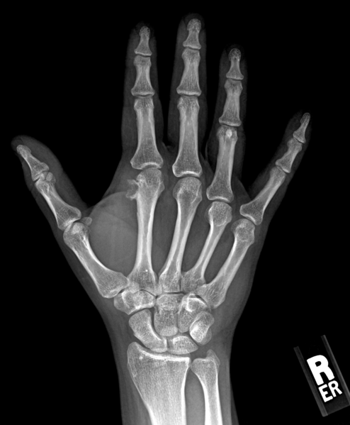 File:Bizarre parosteal osteochondromatous proliferation (Nora lesion) (Radiopaedia 30785-31485 Frontal 1).png