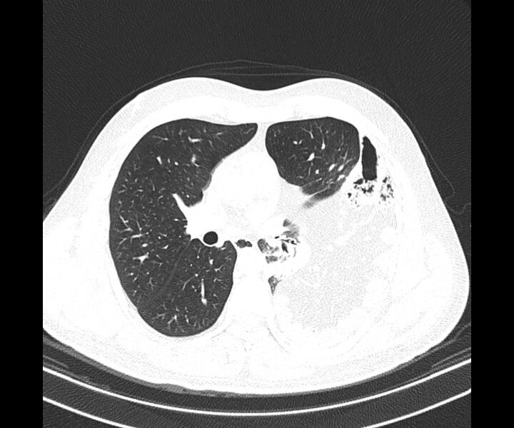 File:Bochdalek hernia - adult presentation (Radiopaedia 74897-85925 Axial lung window 21).jpg