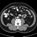 Bosniak cyst - type IV (Radiopaedia 23525-23627 renal cortical phase 46).jpg