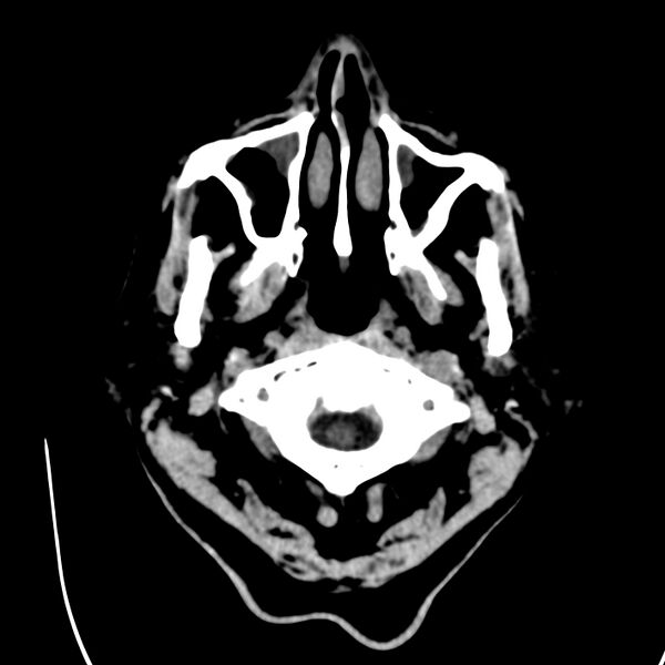 File:Brain Pantopaque remnants (Radiopaedia 78403-91048 Axial non-contrast 9).jpg
