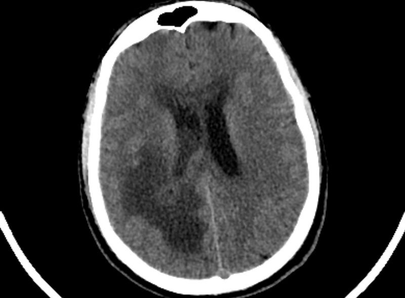 File:Brain abscess complicated by intraventricular rupture and ventriculitis (Radiopaedia 82434-96575 Axial non-contrast 69).jpg