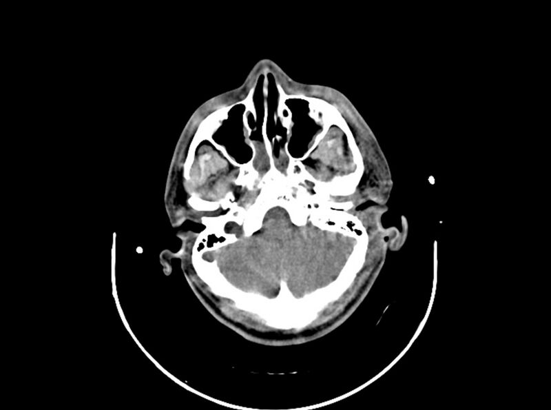 File:Brain injury by firearm projectile (Radiopaedia 82068-96087 B 56).jpg