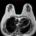 Breast carcinoma (multicentric multifocal in mammary Paget disease) (Radiopaedia 50966-56512 Axial T1 5).jpg