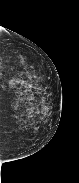 File:Breast hamartoma (Radiopaedia 85726-101518 Left CC 1).PNG