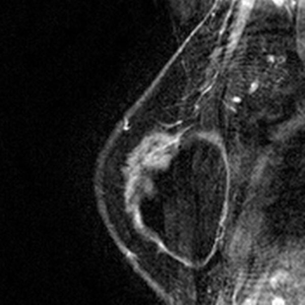 File:Breast implants - MRI (Radiopaedia 26864-27035 Sagittal T2 115).jpg