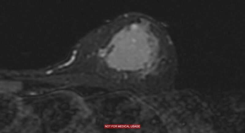 File:Breast lymphoma (MRI) (Radiopaedia 34999-36498 Axial STIR 5).jpg