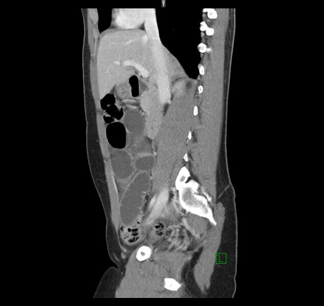 File:Broad ligament hernia (Radiopaedia 63260-71832 C 21).jpg